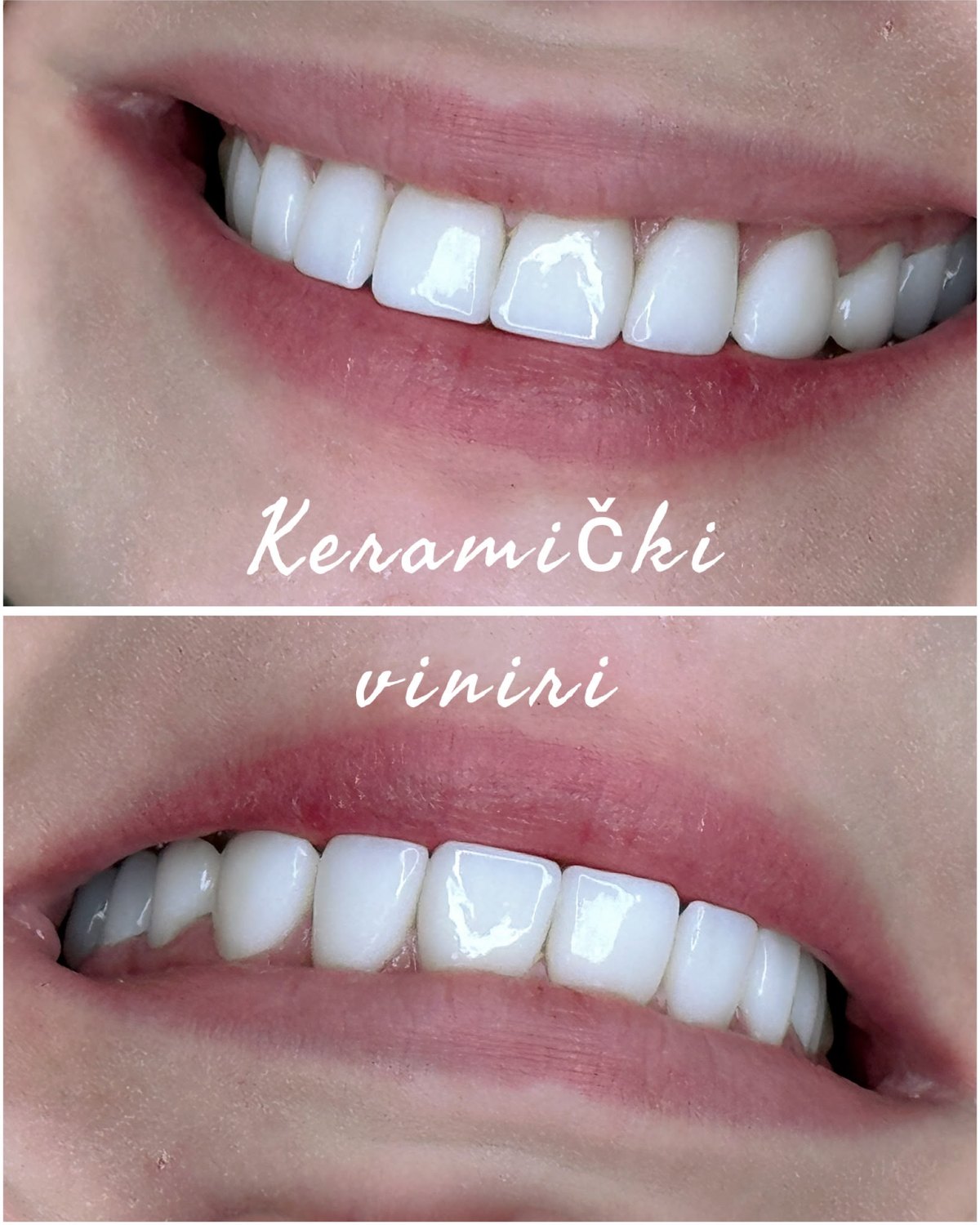 Keramički viniri — detalj prednjih zuba