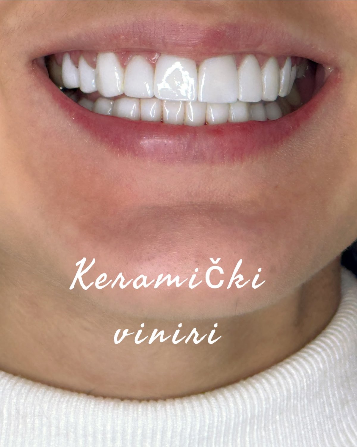 Keramički viniri — nov oblik prednjih zuba