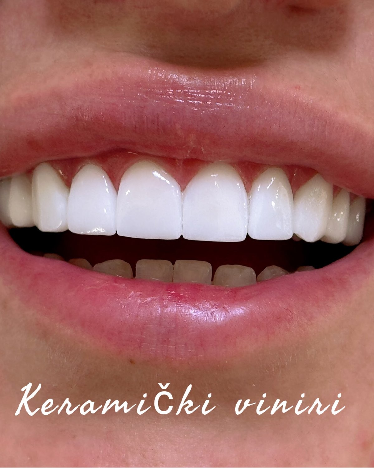 Keramički viniri — krupni plan