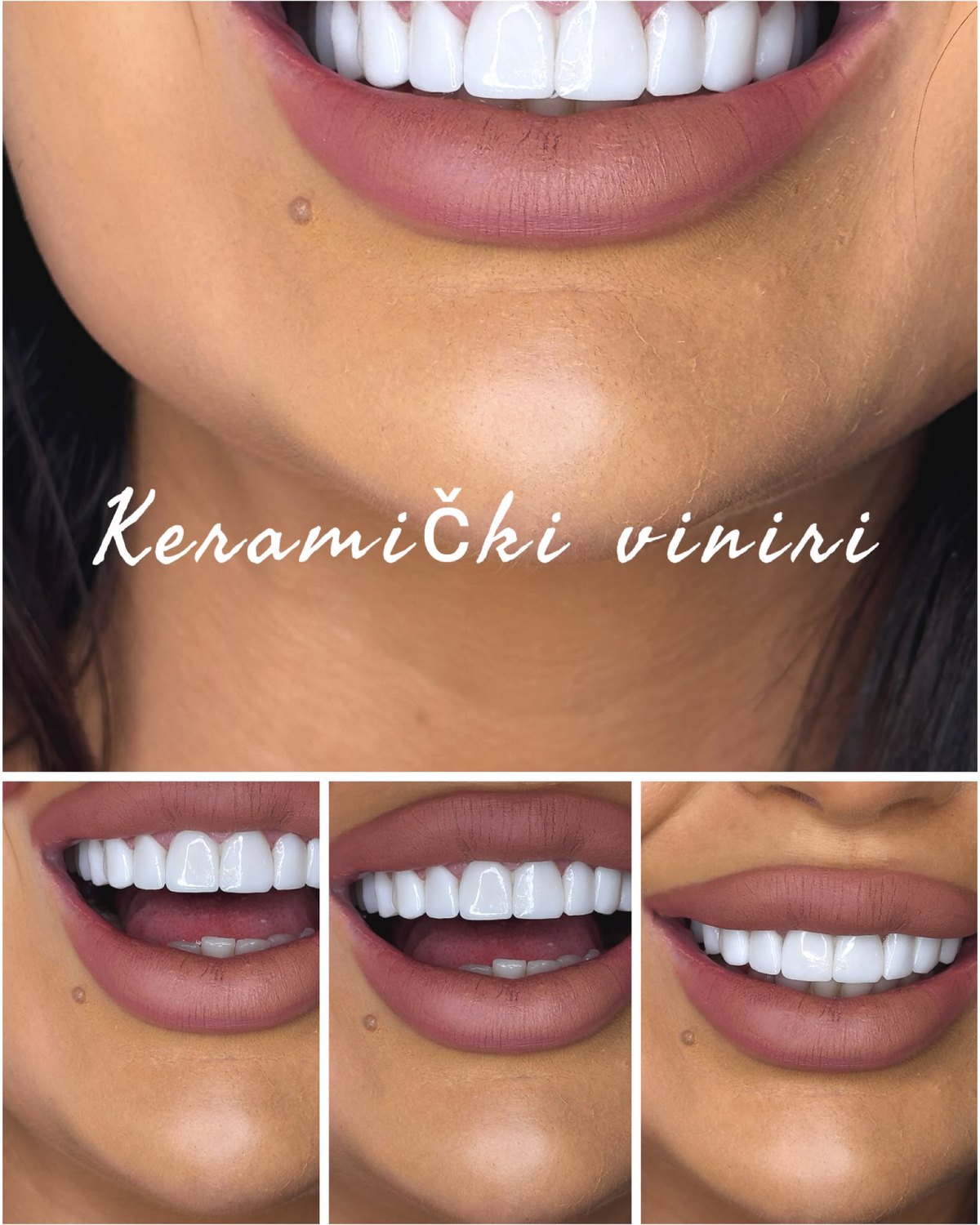 Keramički viniri — rezultat iz nekoliko uglova